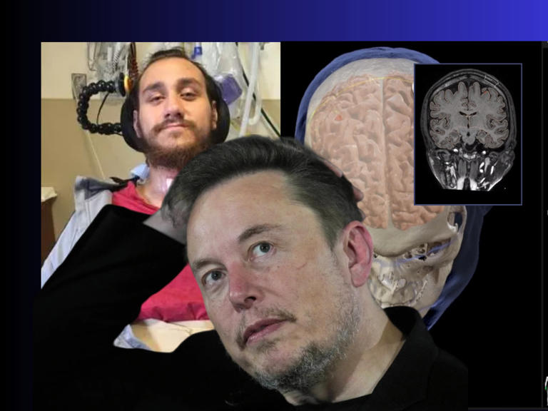 El primer chip cerebral de Neuralink transplantado en un humano se desprende del cráneo del paciente, ¿corre peligro?