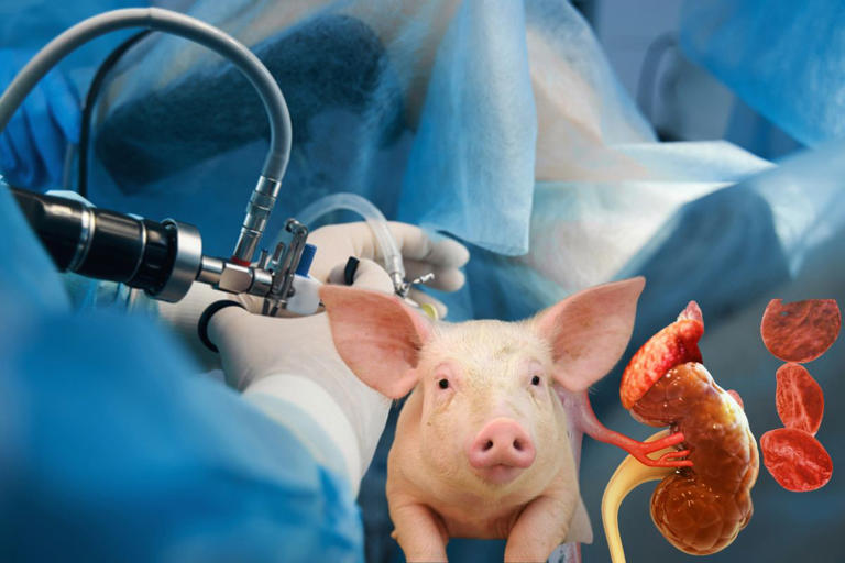 ¿De qué murió el primer paciente en recibir riñón de cerdo modificado genéticamente?