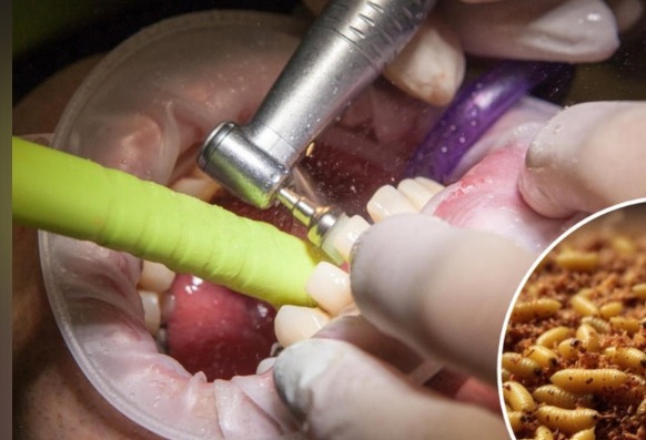 Doctores extraen más de 100 gusanos de la boca de una mujer en Perú